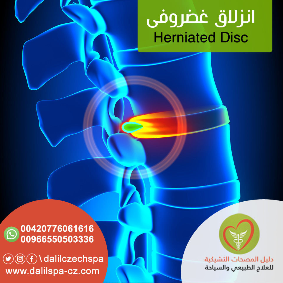 الانزلاق الغضروفي