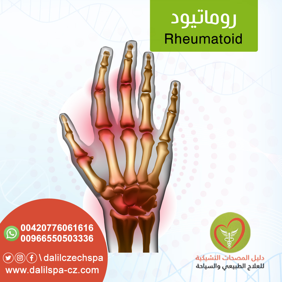 الروماتويد 