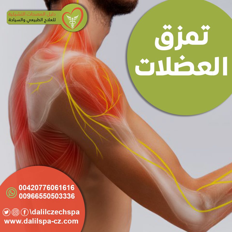 تمزق العضلات و علاجة