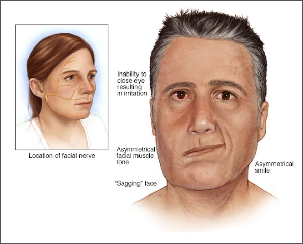 شلل الوجه النصفي 