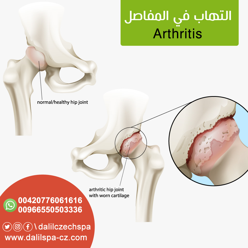 التهاب المفاصل 