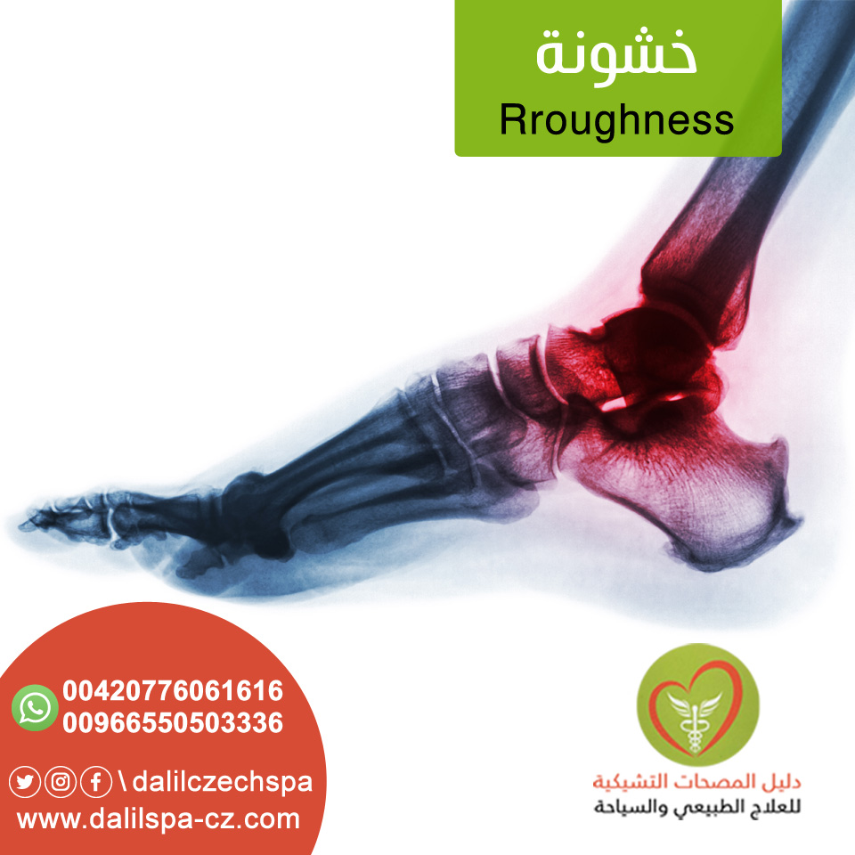 خشونة المفاصل