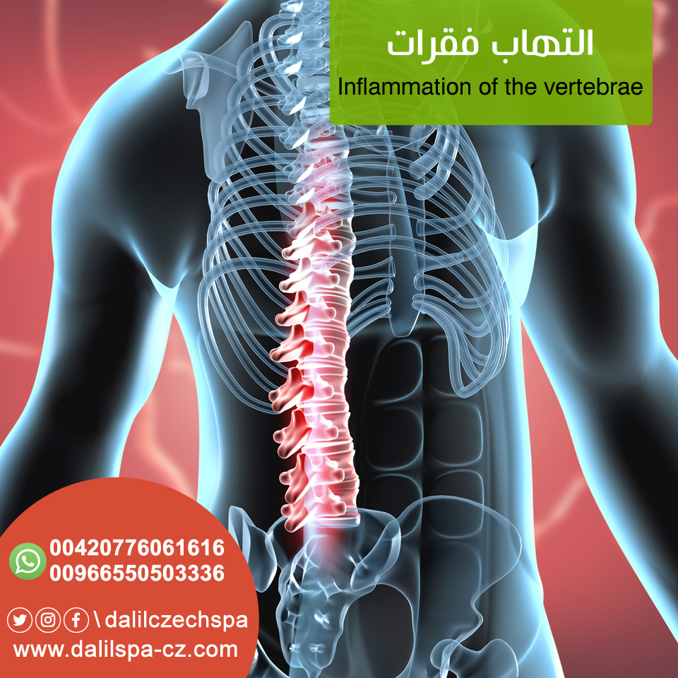 أعراض التهاب فقرات العمود الفقريّ